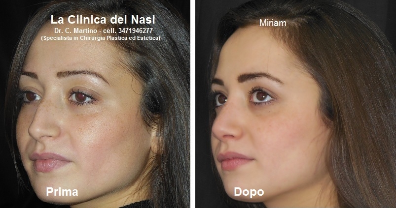 rhinoplasty italy
